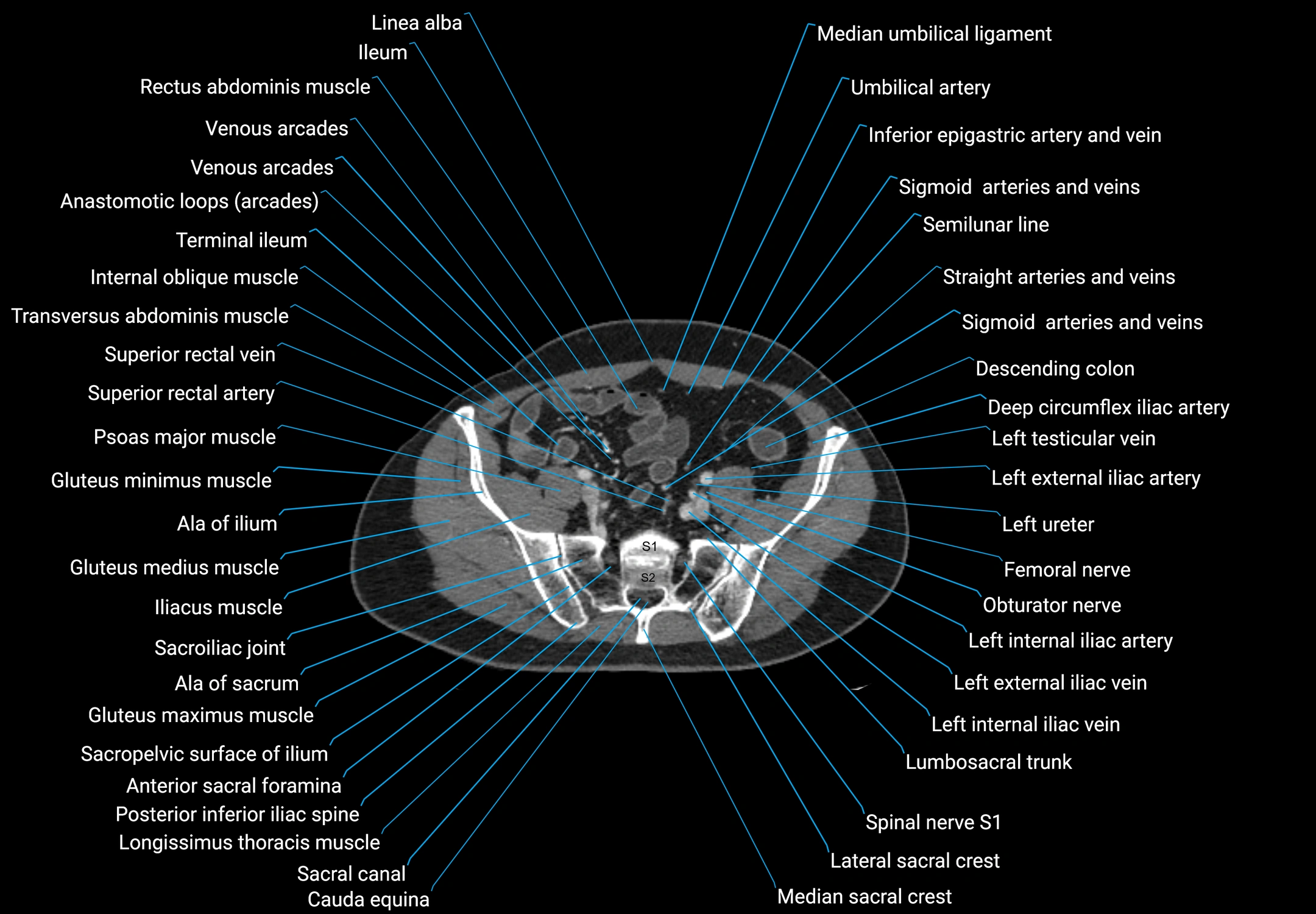 CT male pelvis axial cross sectional anatomy labelled radiology image -00147.webp
